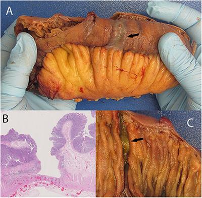 Refractory Celiac Disease Type II: A Case Report and Literature Review